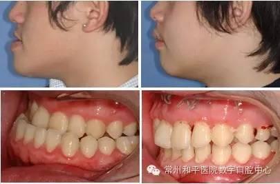 咬牙成人矫正视频,跟随视频见证成人牙齿矫正全过程-第1张图片-亚洲AV中文无码乱人伦