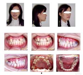 咬牙成人矫正视频,跟随视频见证成人牙齿矫正全过程-第3张图片-亚洲AV中文无码乱人伦
