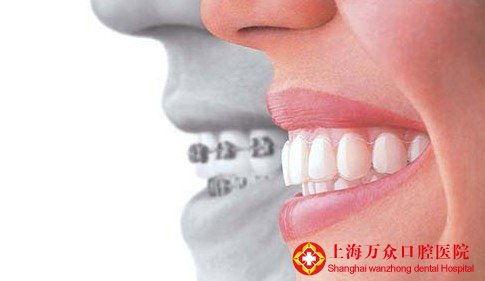 成人牙齿整形视频,成人矫正全过程解析-第1张图片-亚洲AV中文无码乱人伦