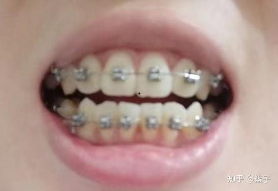 成人牙齿整形视频,成人矫正全过程解析-第2张图片-亚洲AV中文无码乱人伦