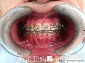 成人自己拔牙视频大全,视频大全揭秘-第3张图片-亚洲AV中文无码乱人伦